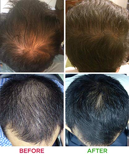 SaIe: iRestore Laser Hair Growth System - Essential - Restore Laser Cap FDA Cleared Hair Loss Treatments: Hair Regrowth for Men and Women with Thinning Hair - Helmet Laser Comb Hair Growth Products